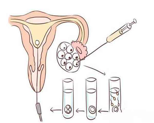 试管婴儿怎么选男女_狐臭借卵做试管_试管婴儿胚胎移植后 你的冰箱里该放哪些