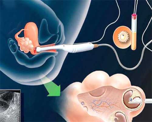 南京医院我们代孕手术费 做一代试管的南京鼓楼会挑出A级精子吗？ ‘二胎生了