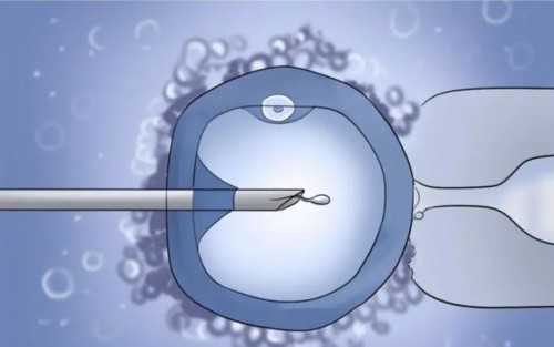 试管婴儿包男孩多少钱_试管婴儿双胞胎_【取卵手术过程图】试管婴儿取卵手术