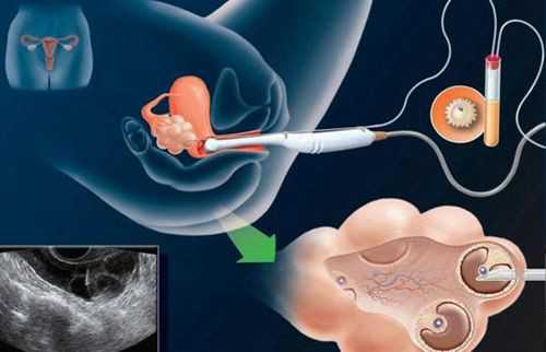 试管婴儿可以筛选遗传病吗_想生龙凤胎可以试管吗_三代试管：「无创胚胎染色