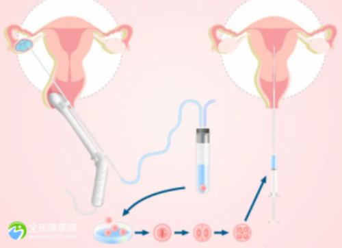 试管婴儿二代能选择男女吗_如何做试管婴儿流程_Vm5iU_3Vvuh_g313G_准备500元给胎儿