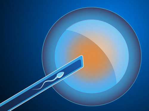 试管婴儿复苏要多少钱_试管婴儿能生双胞胎吗_双侧输卵管盆腔周围粘连有一边