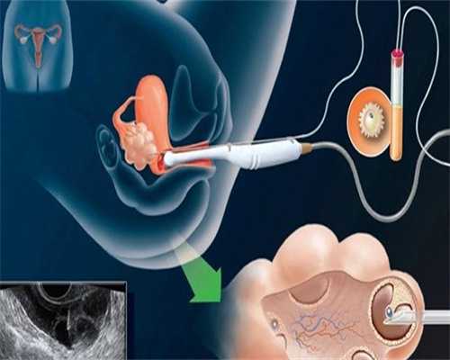 第四代试管_试管婴儿咨询医生_试管婴儿是一个什么样的过程？