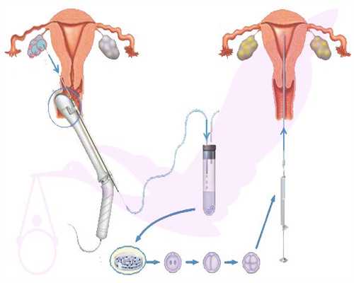 南京做代怀前的检查 南京试管助孕为什么失败？原因就是这些 ‘nt值男宝女宝